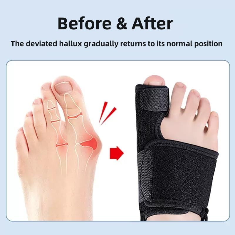 Recovist Bunion Brace - Adjustable Orthopedic Splint for Hallux Valgus Correction & Pain Relief, Day & Night Wear Support for Men & Women 2PC